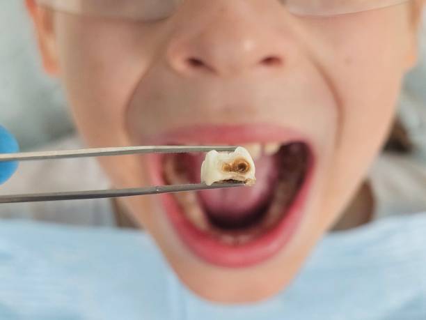 Best Emergency Treatment for Toothache in Kimberling City, MO